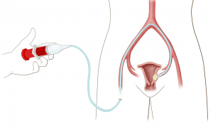 Embolização uterina